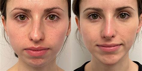 Answer Bumps after rhinoplasty at the nose-cheek junction. . Bumped my nose 1 month after rhinoplasty